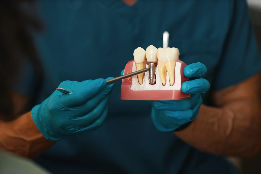A model of how dental implants are done.